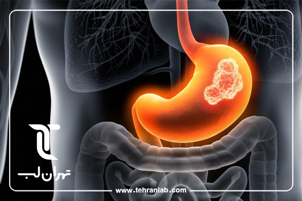 تست خون برای تشخیص سرطان گوارش